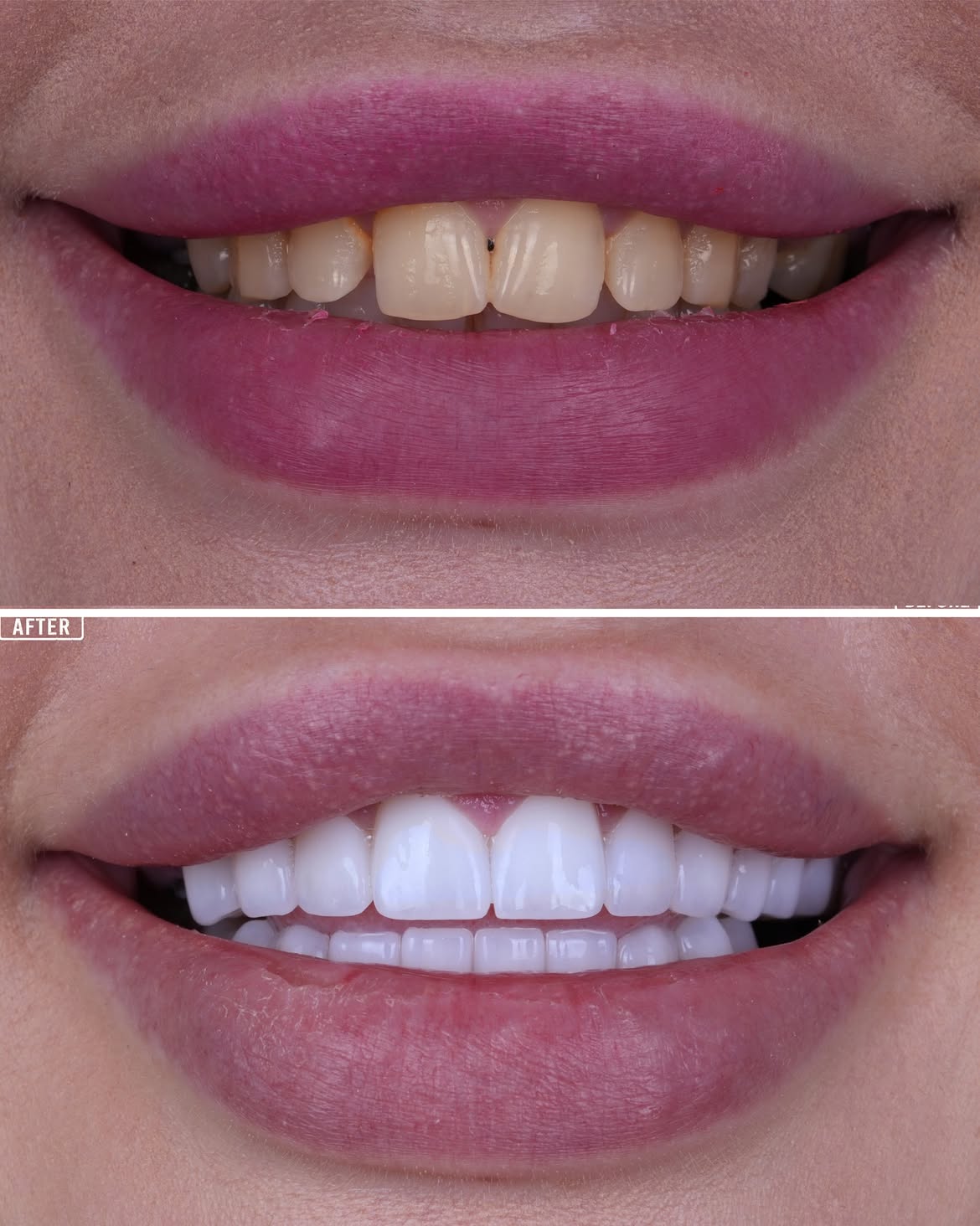 Turkey Teeth Veneers before and after 14
