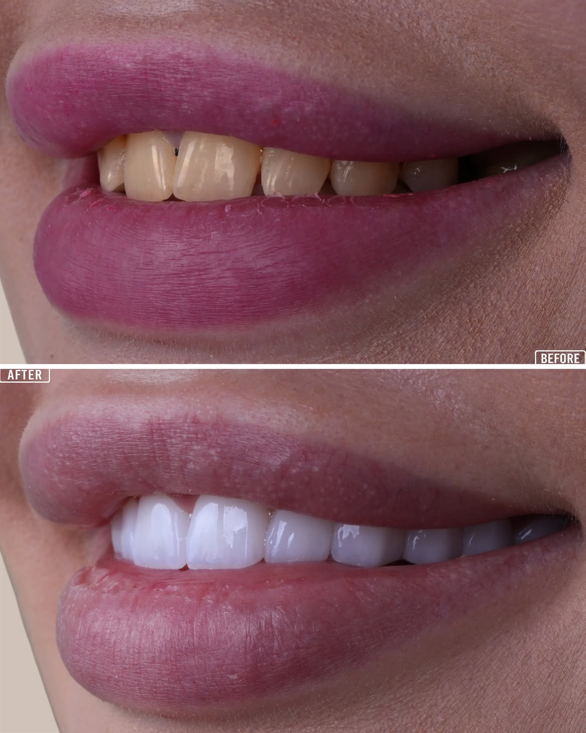 Turkey Teeth Veneers before and after 15