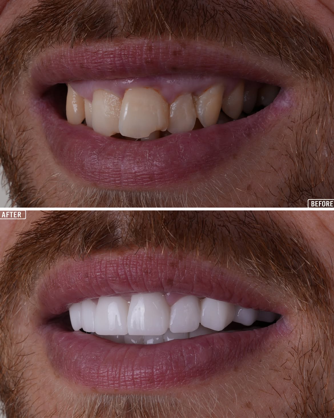 Turkey Teeth Veneers before and after 5