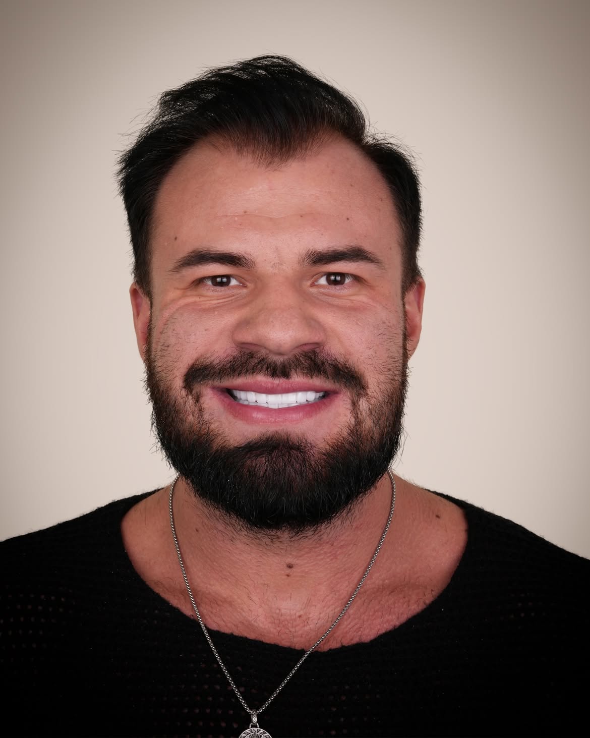 Turkey Teeth Veneers before and after 8