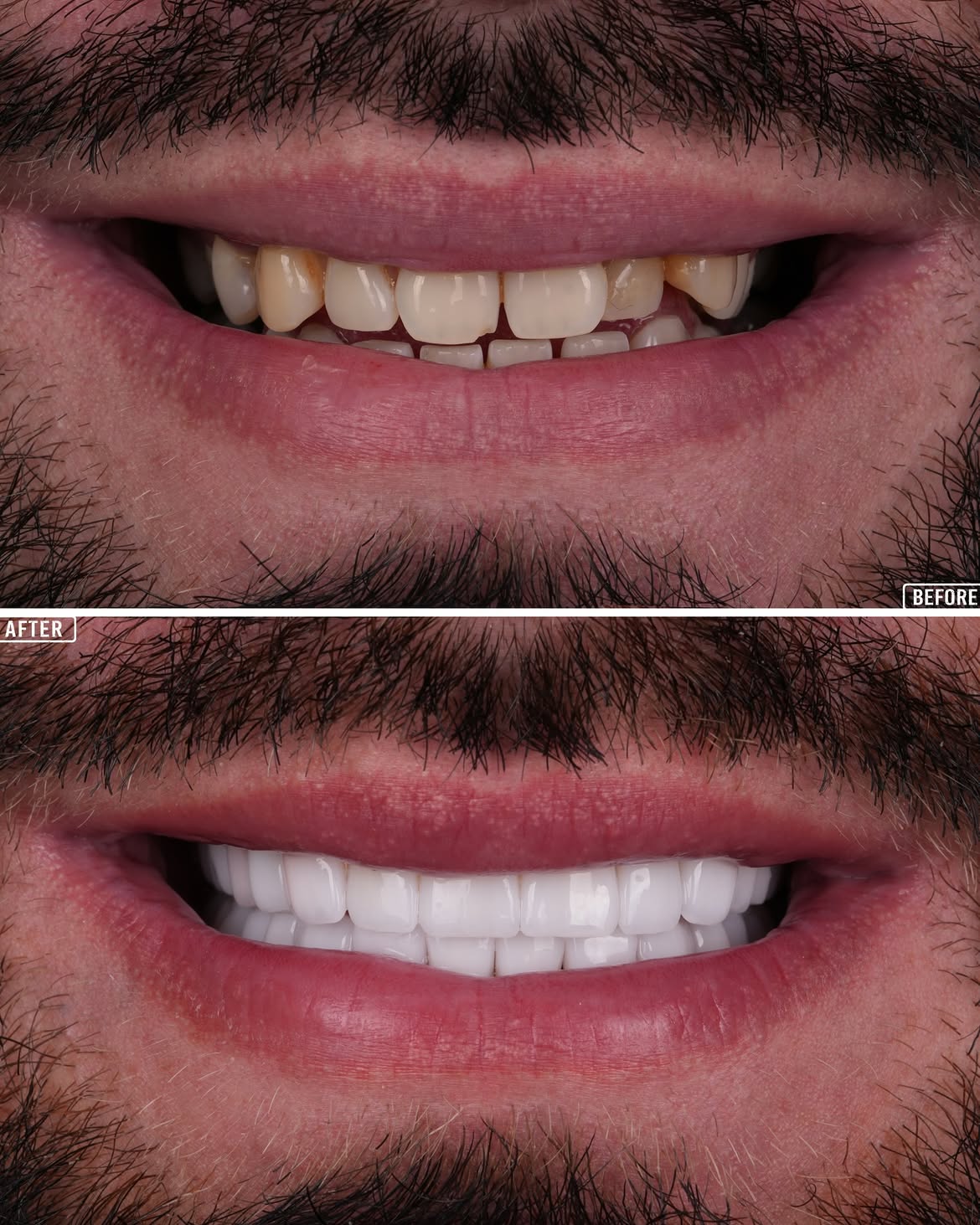 E-max before and after 1  