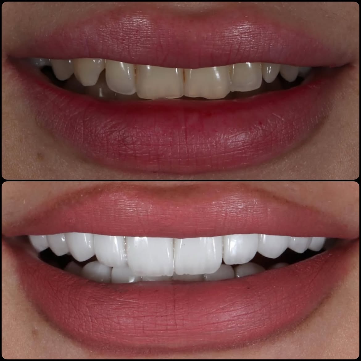 Dental Veneers: Benefits and Limitations 