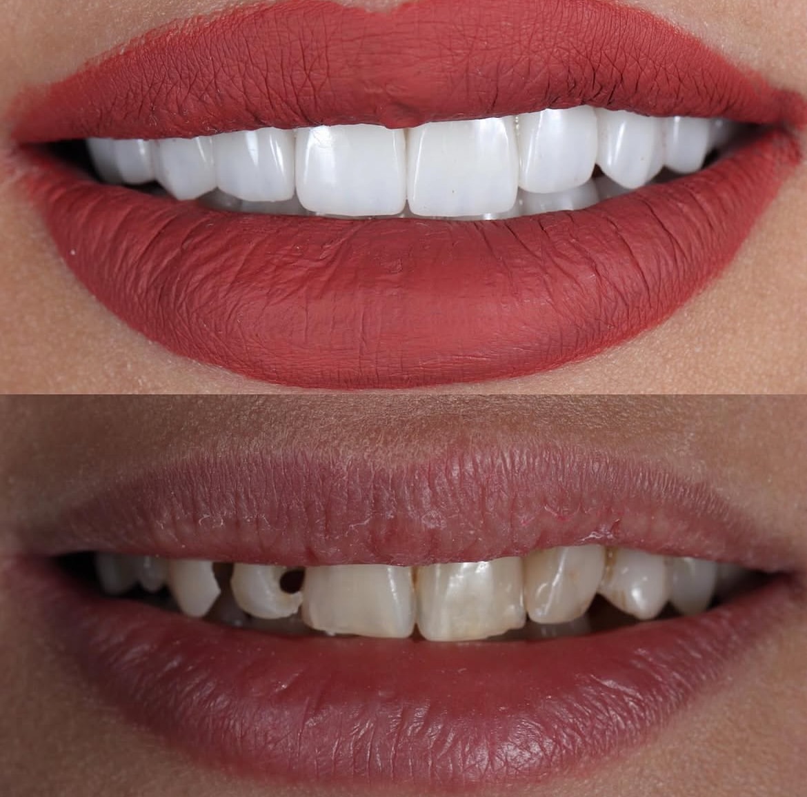 Who is a good candidate for dental veneers? 