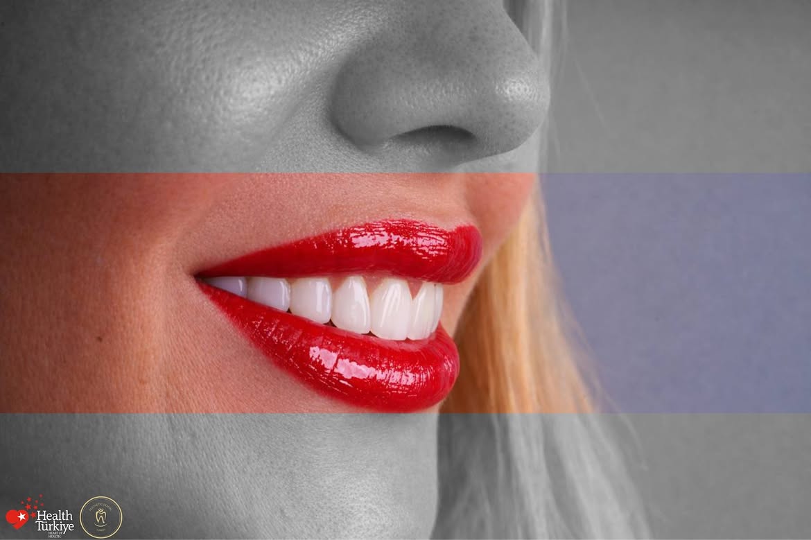 Why dental veneers in Turkey?   