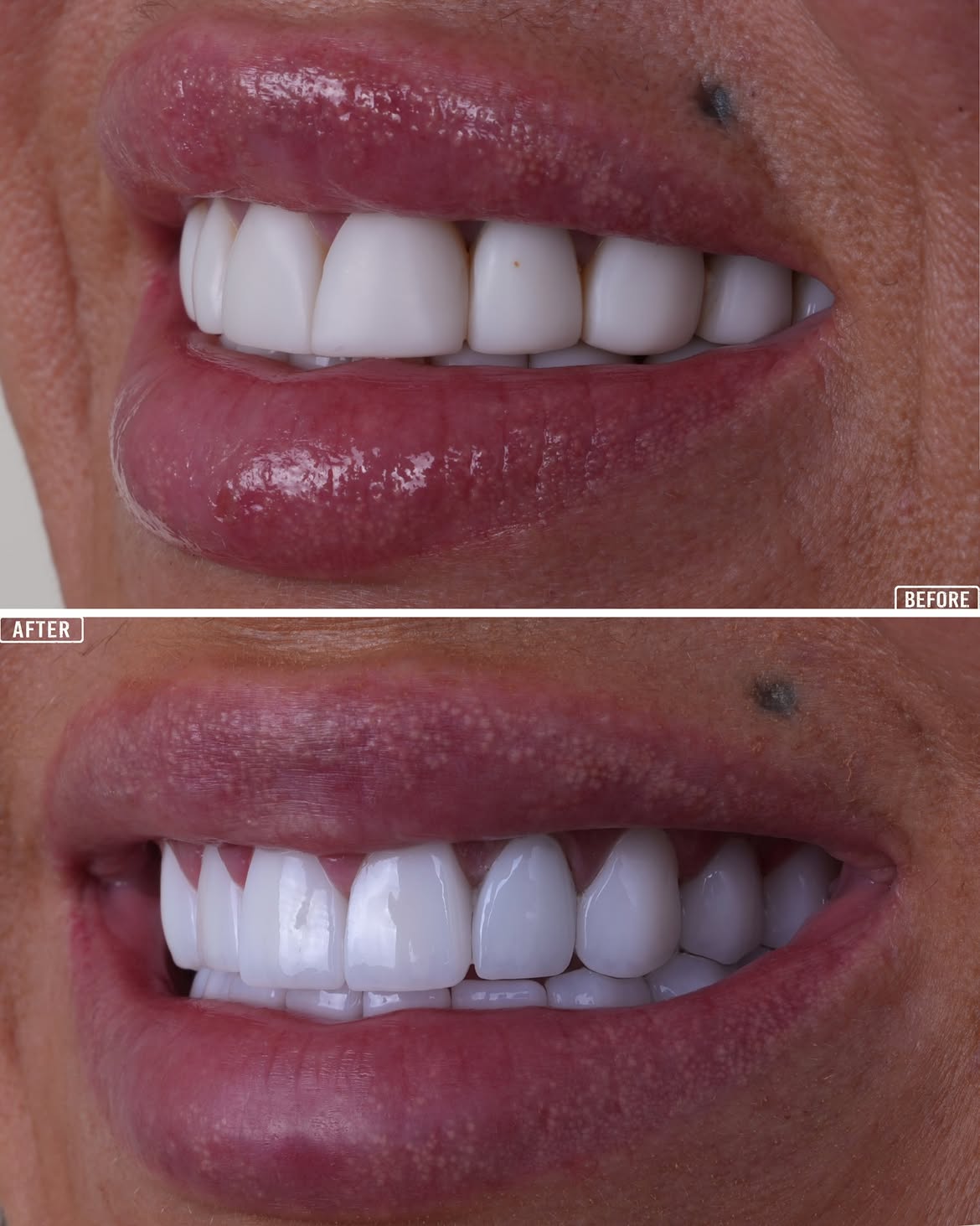 E-max before and after 2 