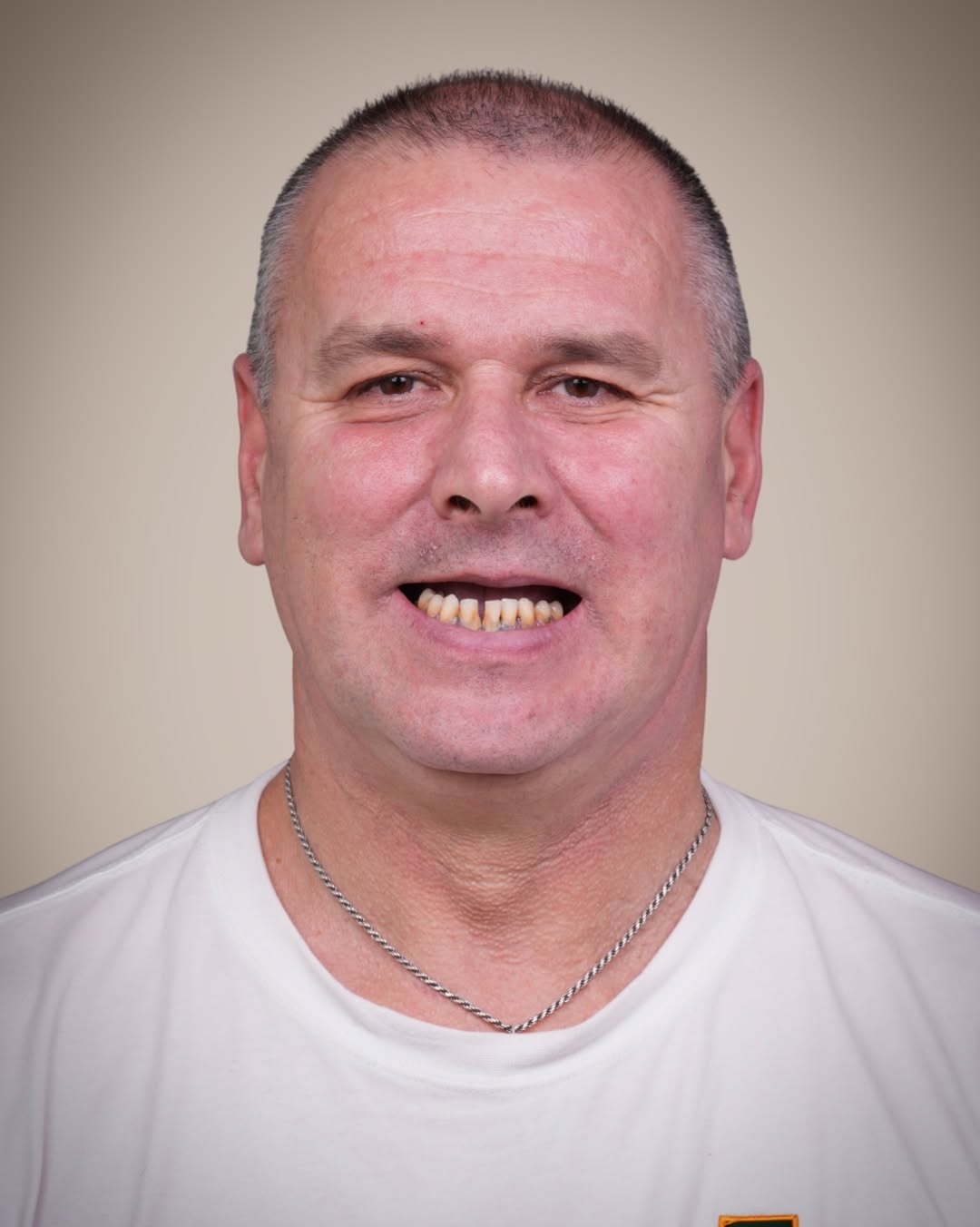 All-on-6 Dental Implants before and after 1