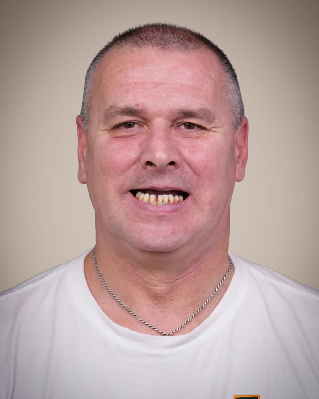 All-on-6 Dental Implants before and after 1