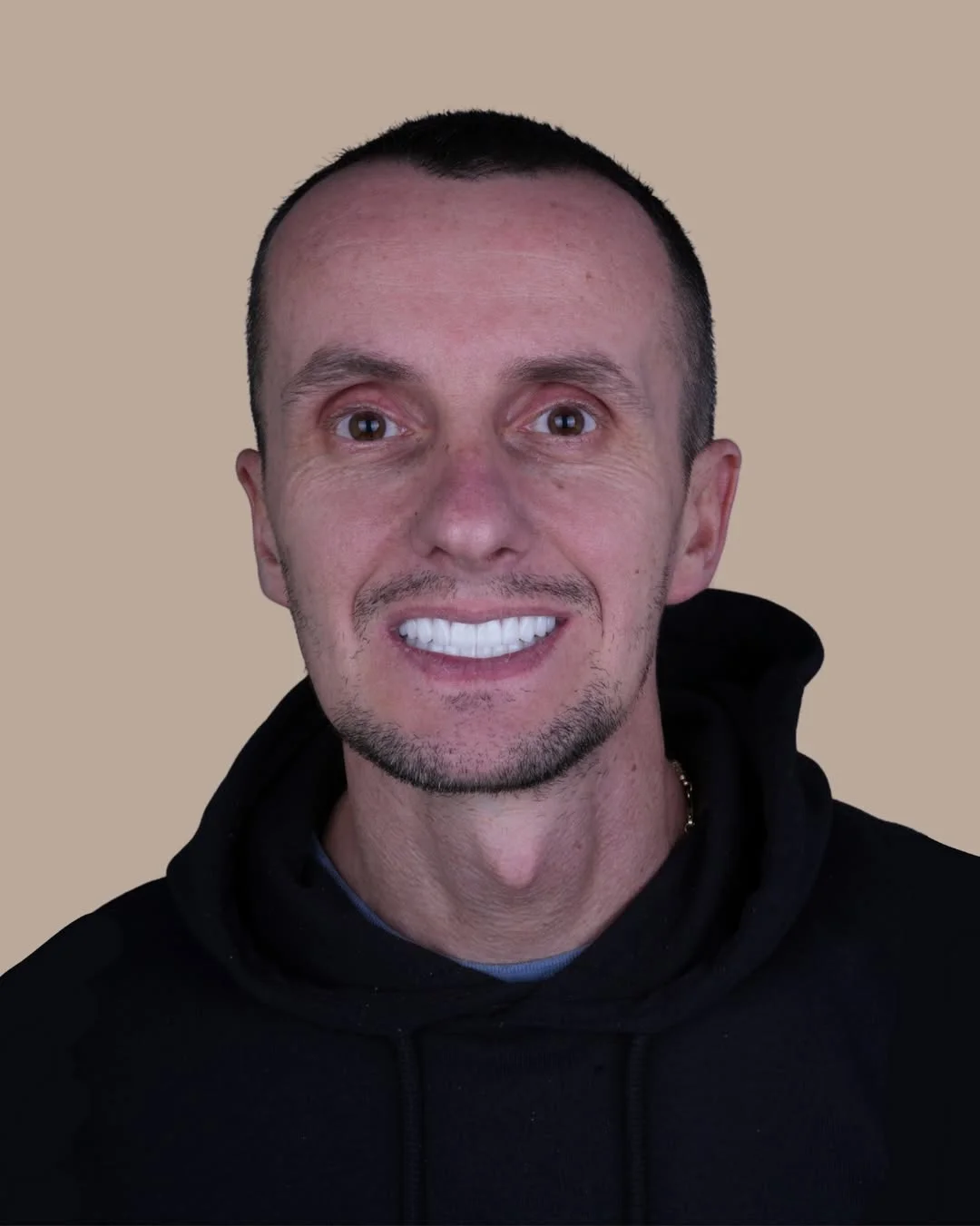 All-on-6 Dental Implants before and after 10