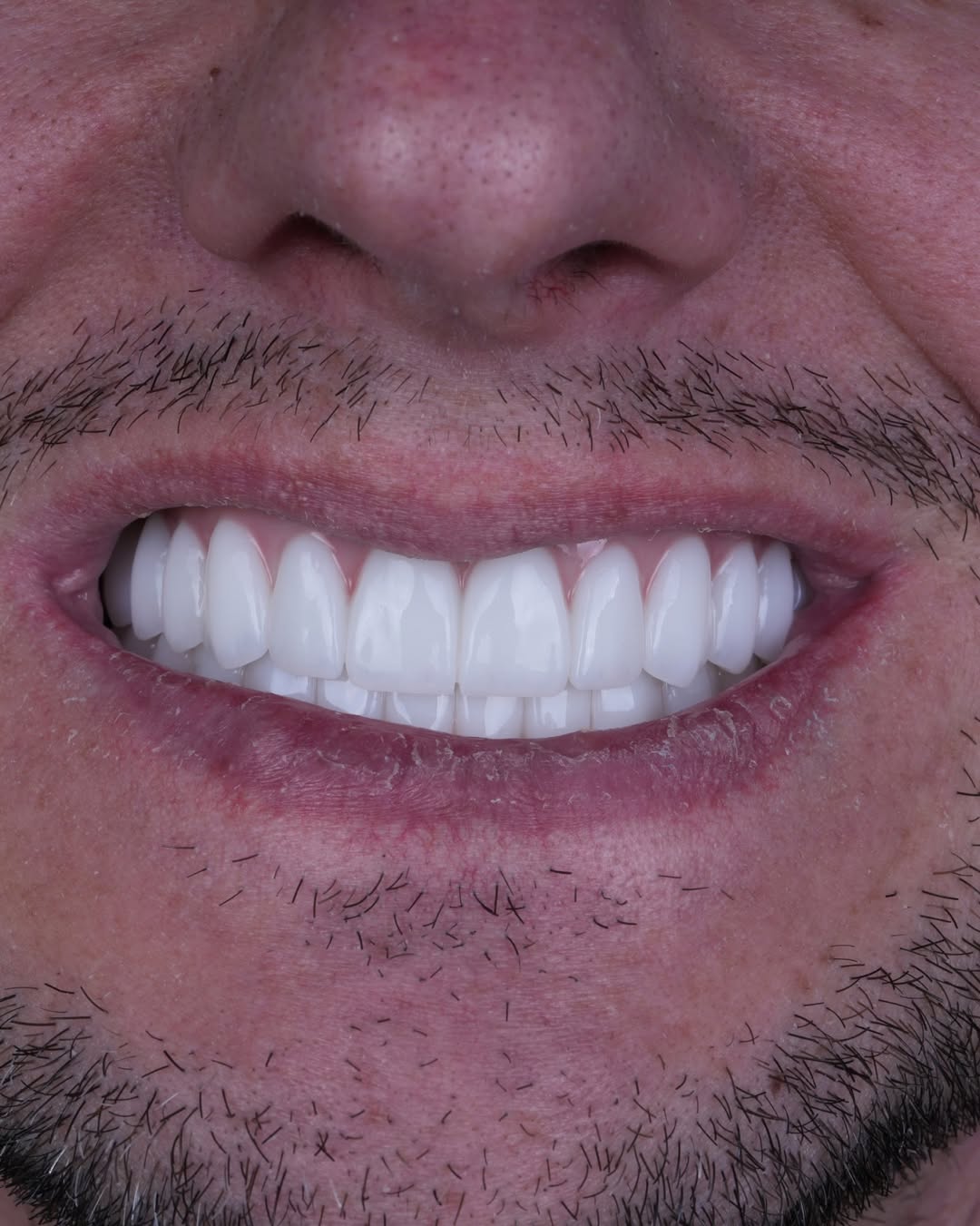 All-on-6 Dental Implants before and after 11