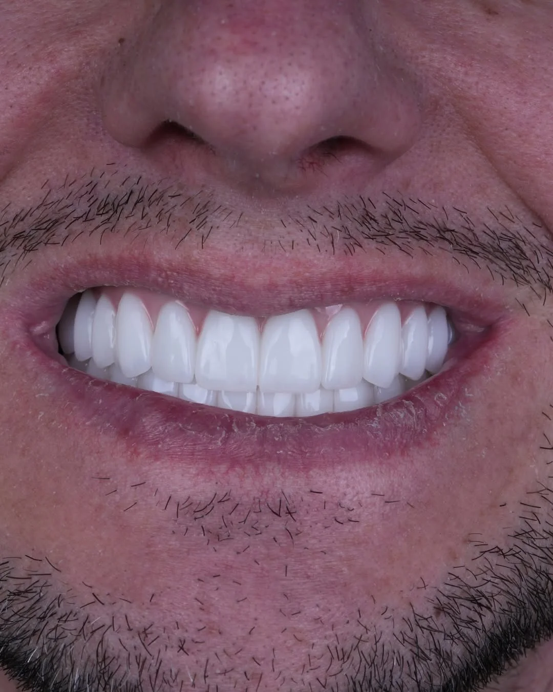 All-on-6 Dental Implants before and after 11