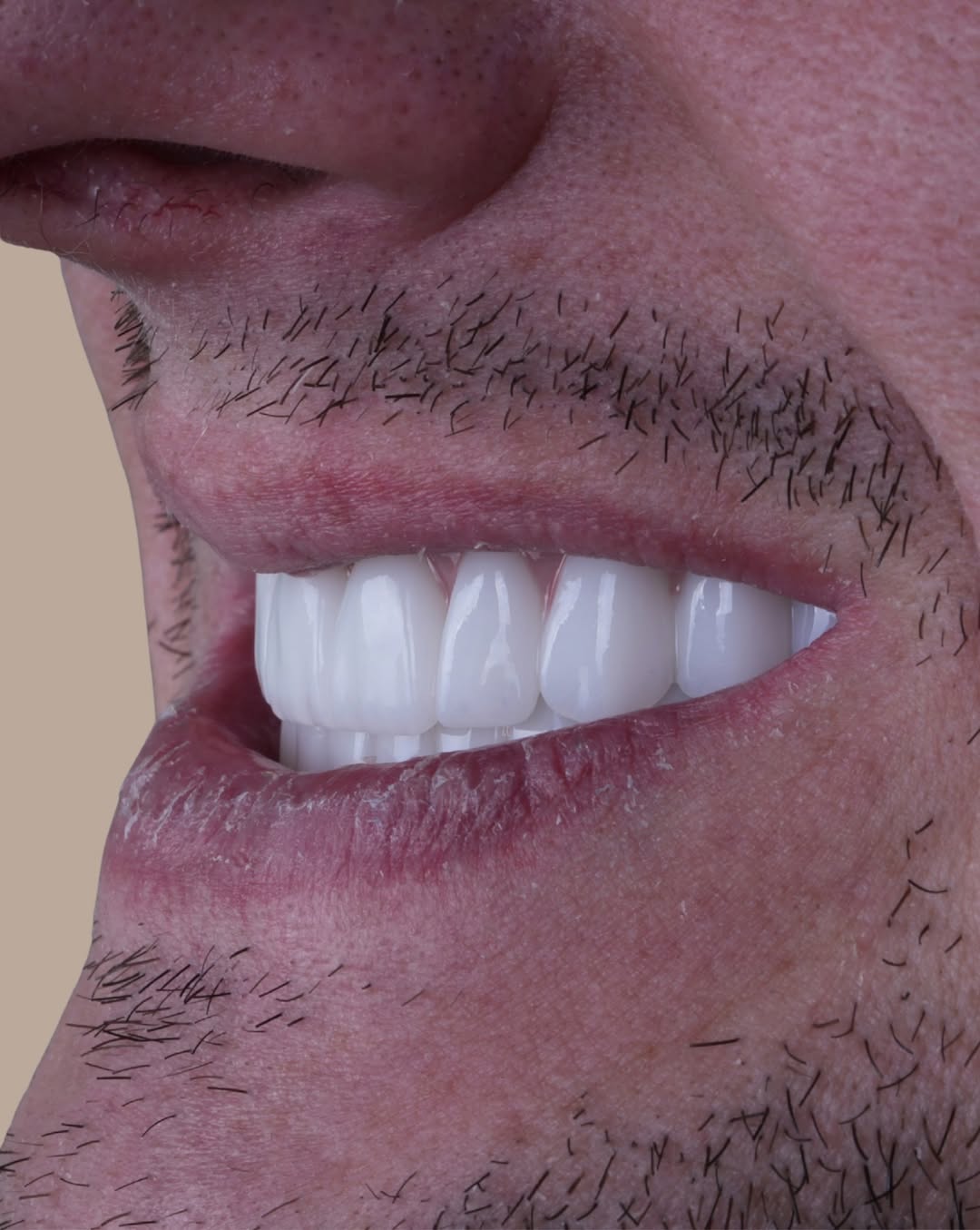 All-on-6 Dental Implants before and after 12
