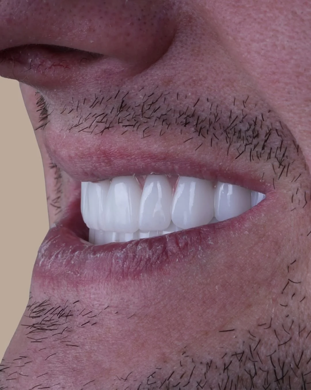 All-on-6 Dental Implants before and after 12