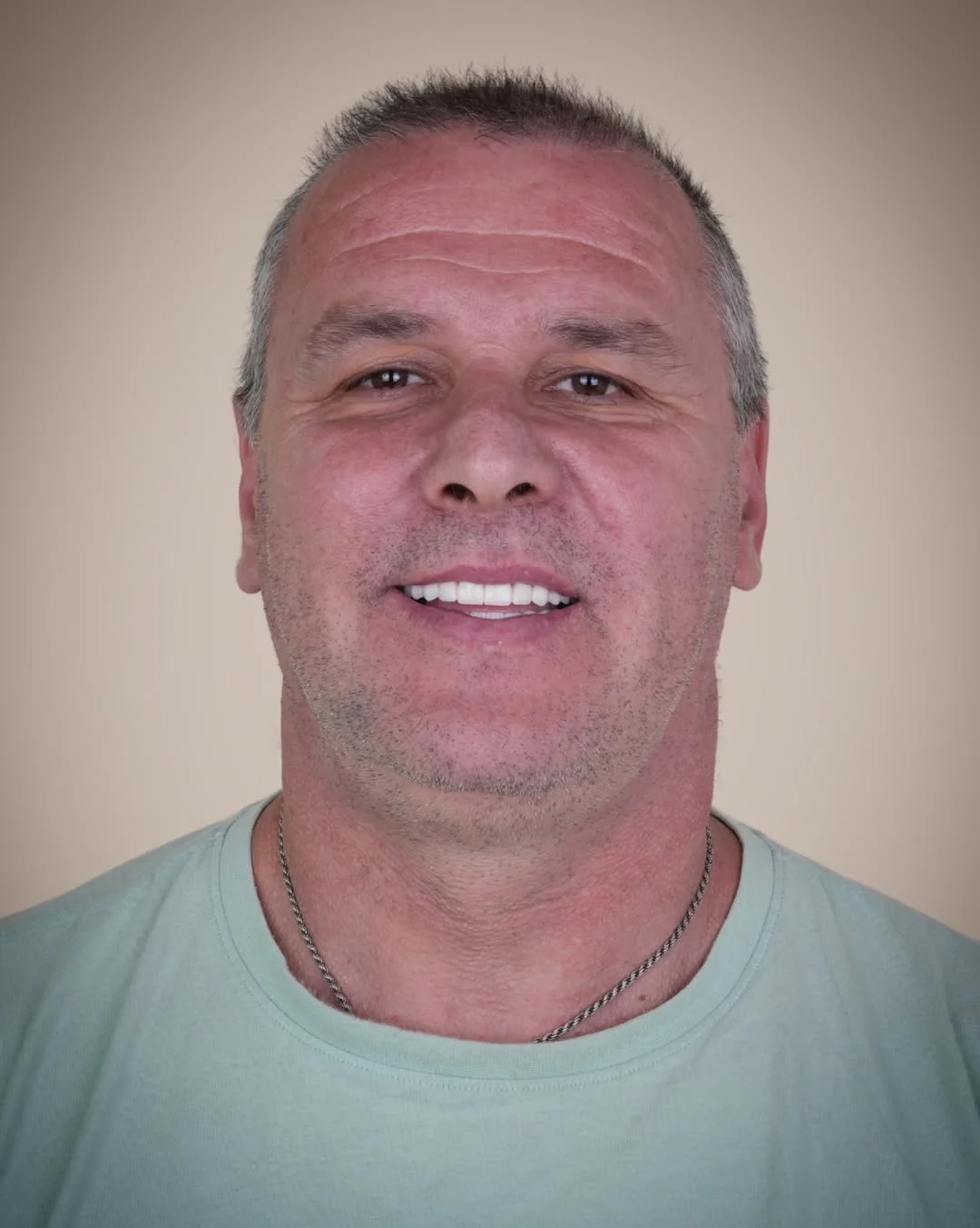 All-on-6 Dental Implants before and after 2