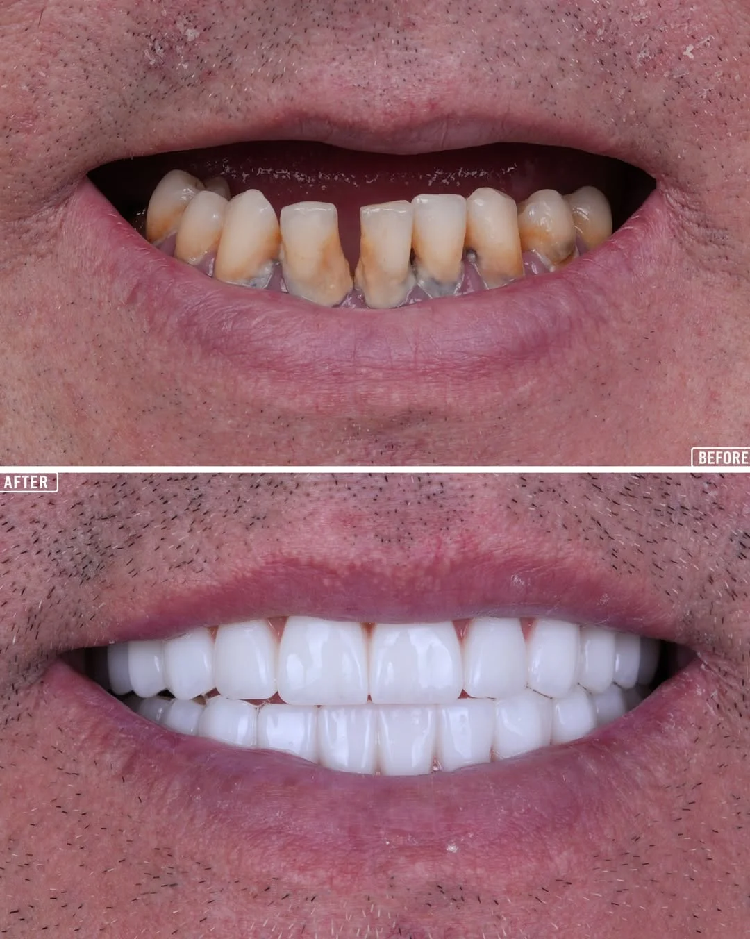 All-on-6 Dental Implants before and after 3