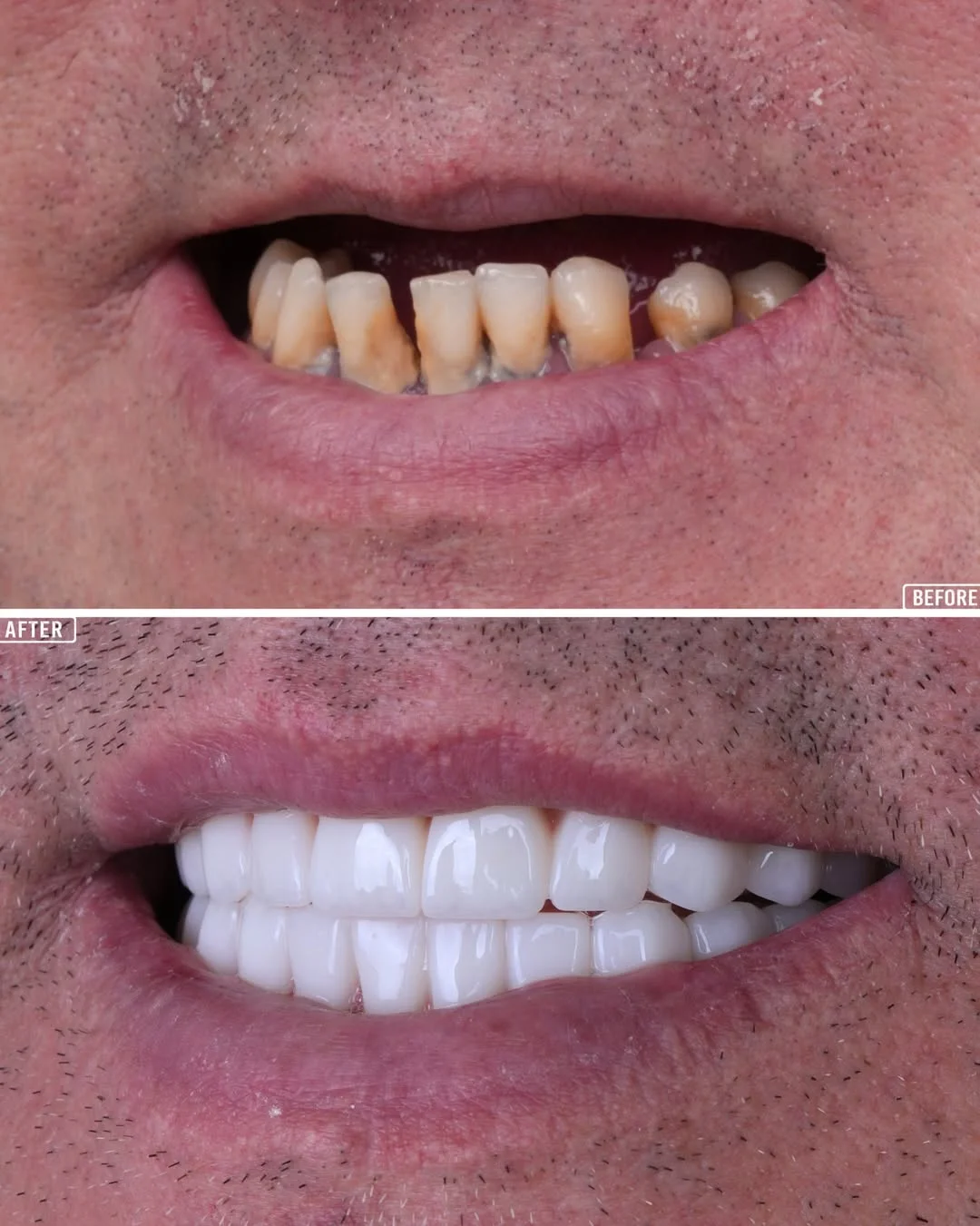 All-on-6 Dental Implants before and after 4