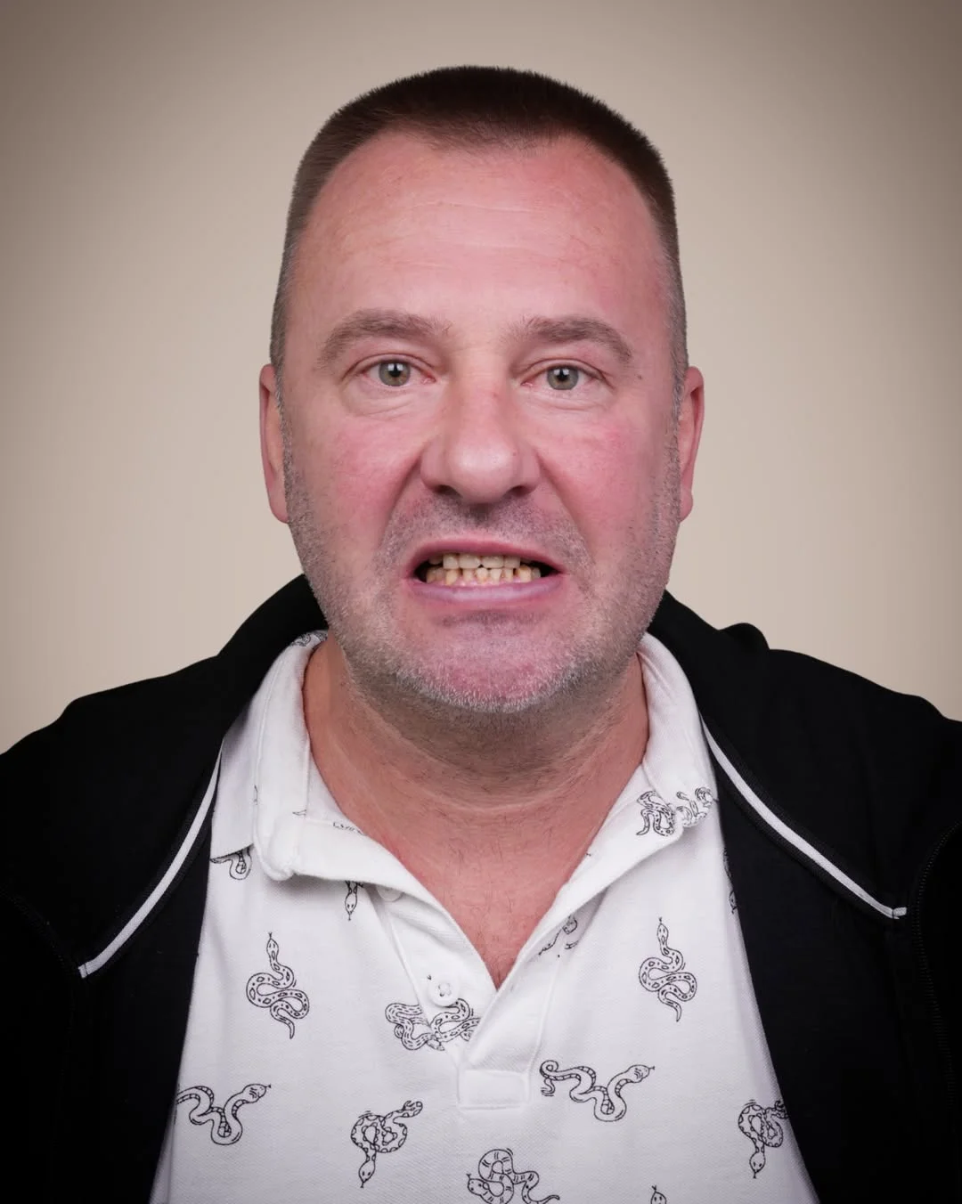 All-on-6 Dental Implants before and after 5