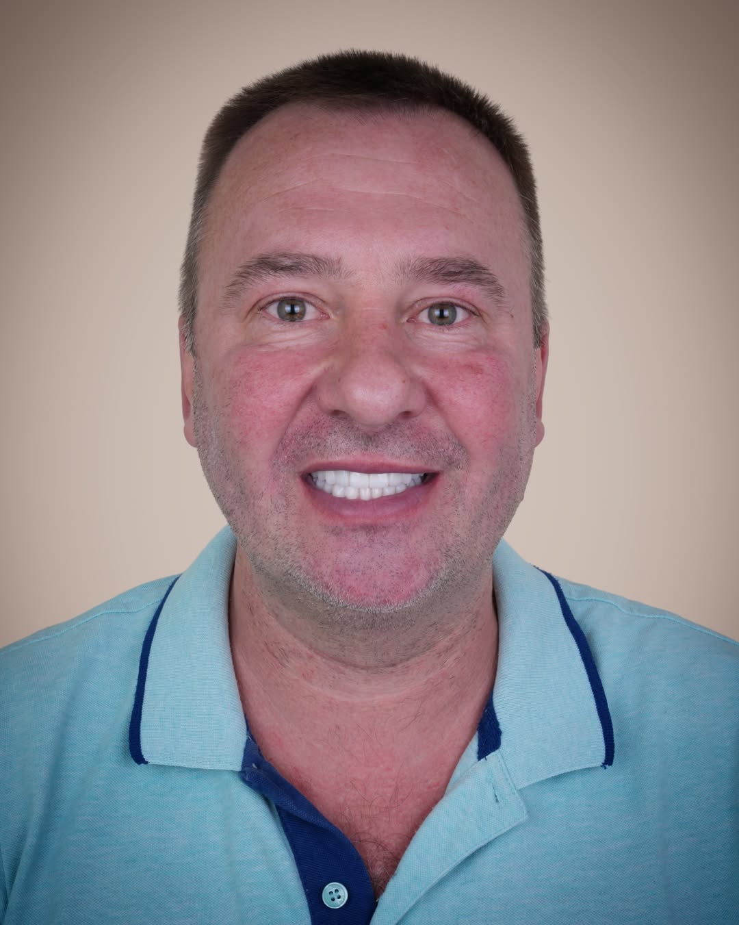 All-on-6 Dental Implants before and after 6