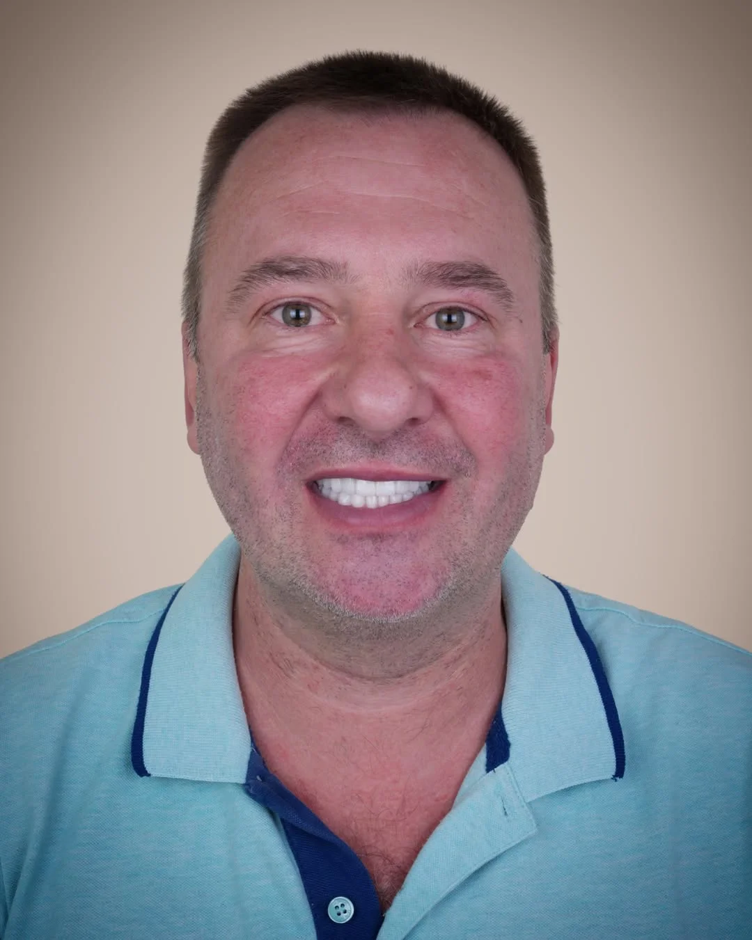 All-on-6 Dental Implants before and after 6