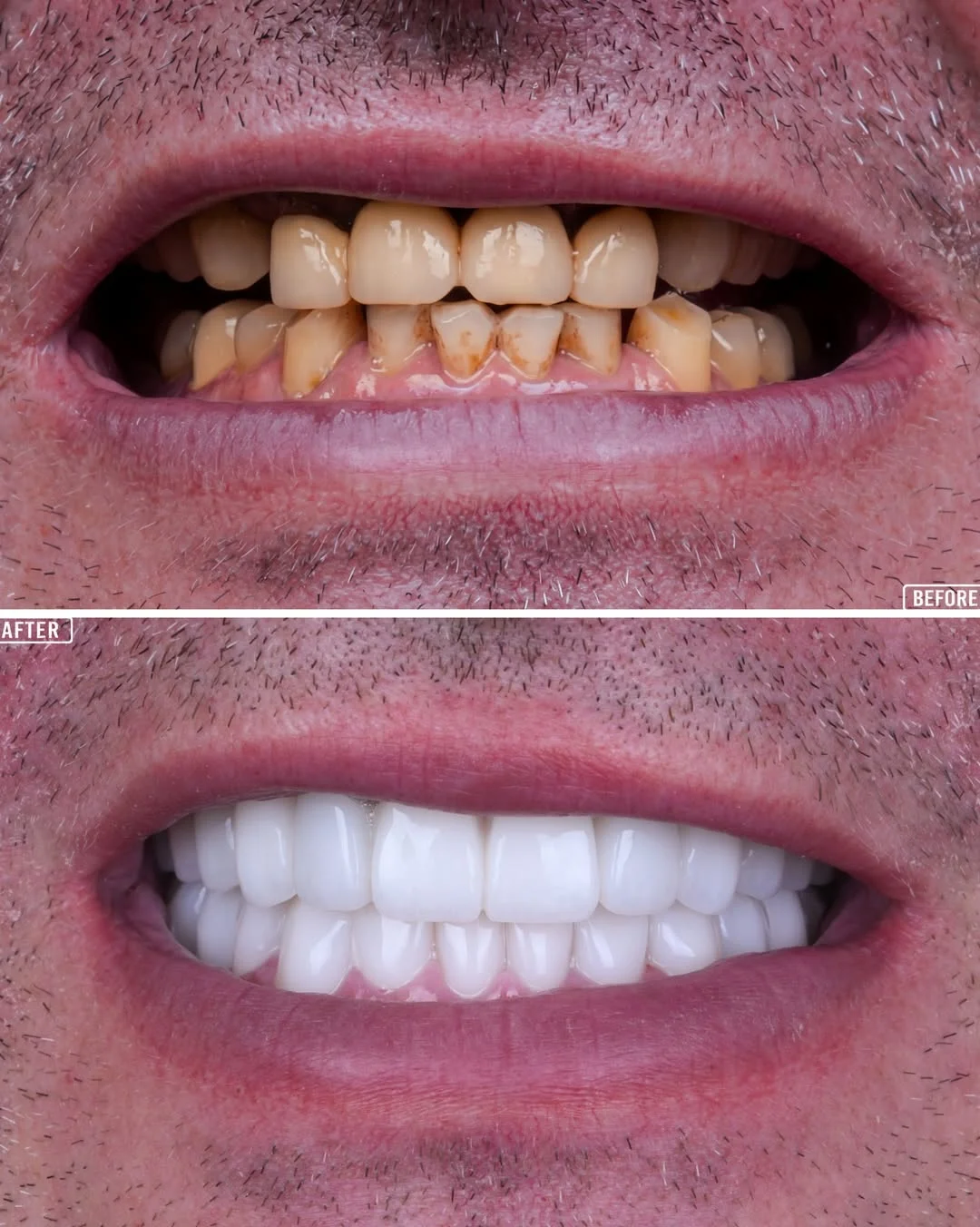 All-on-6 Dental Implants before and after 7
