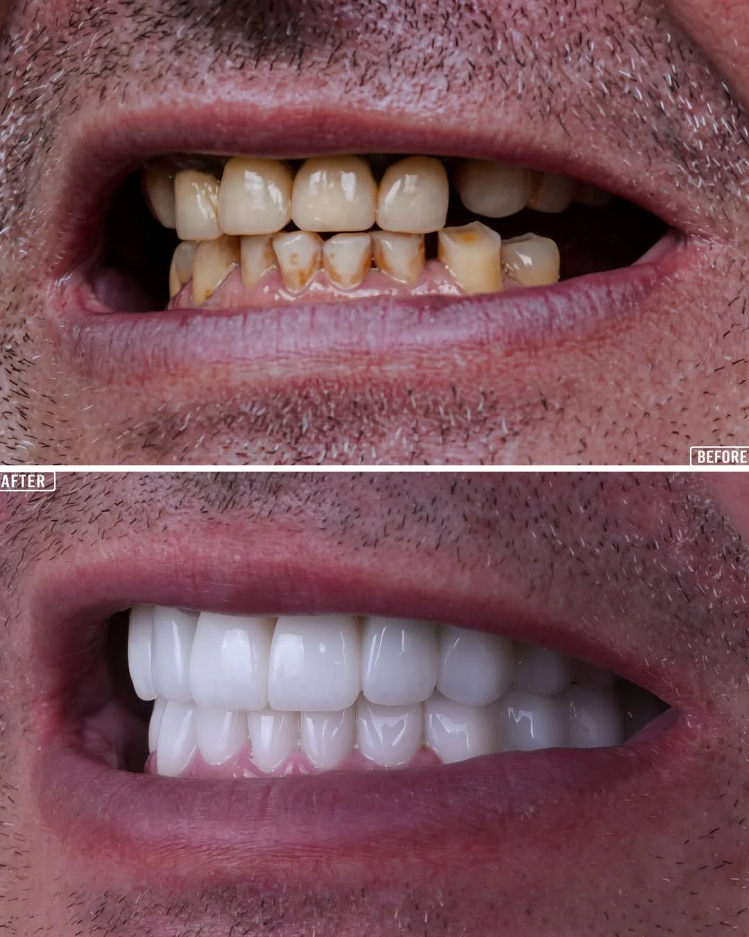 All-on-6 Dental Implants before and after 8