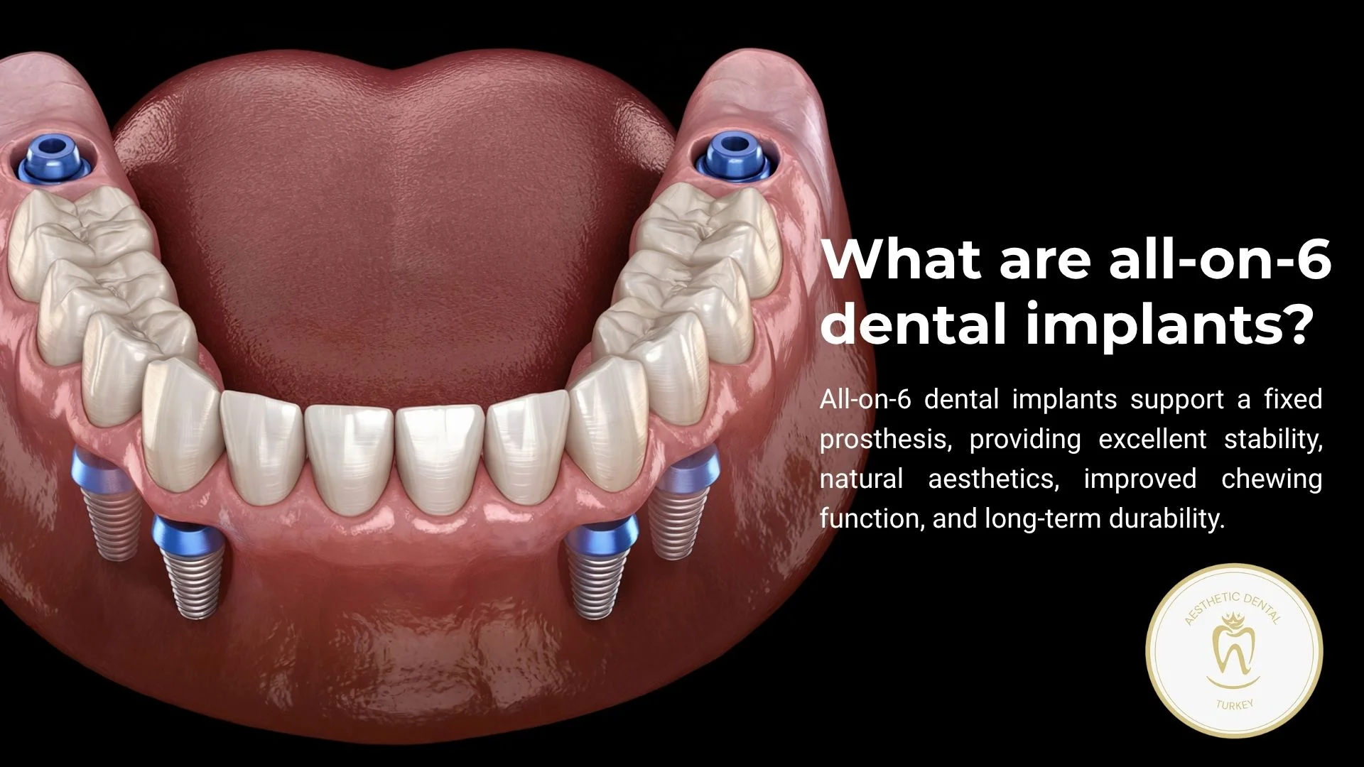 what-is-all-on-6-dental-implants-turkey-antalya?