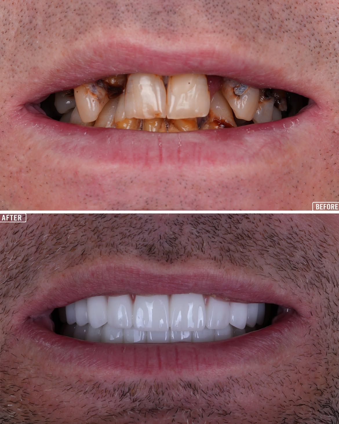 Smile Makeover Before & After in Antalya, Turkey 10