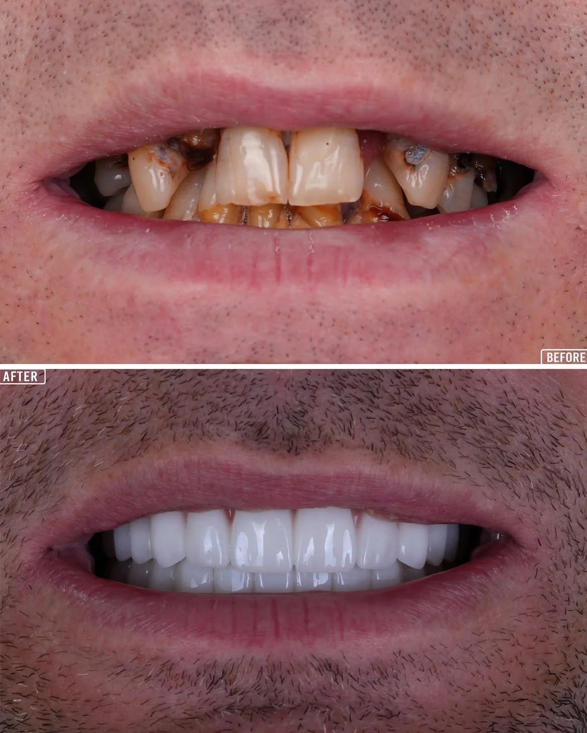 Smile Makeover Before & After in Antalya, Turkey 10