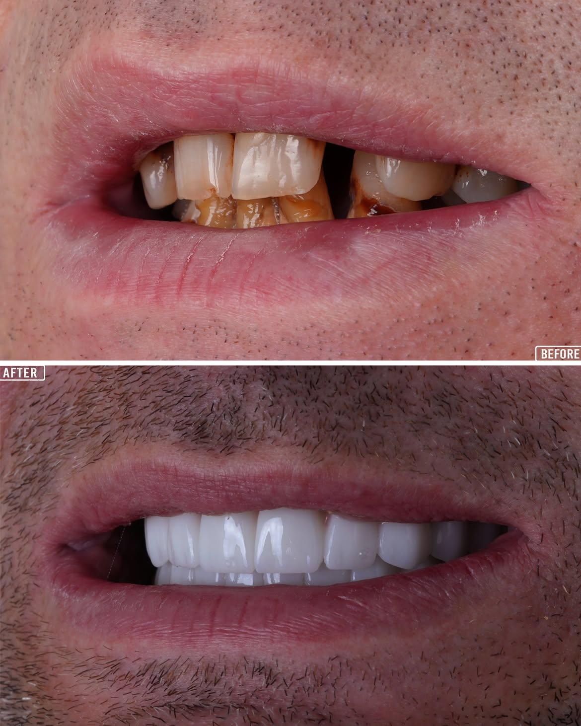 Smile Makeover Before & After in Antalya, Turkey 11
