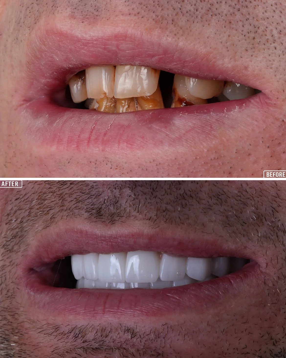 Smile Makeover Before & After in Antalya, Turkey 11