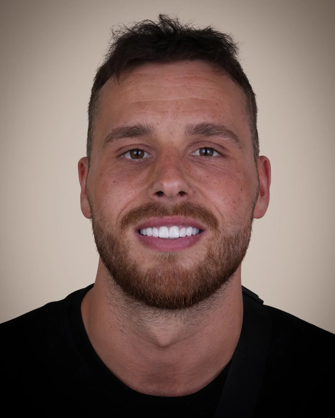 Smile Makeover Before & After in Antalya, Turkey 14