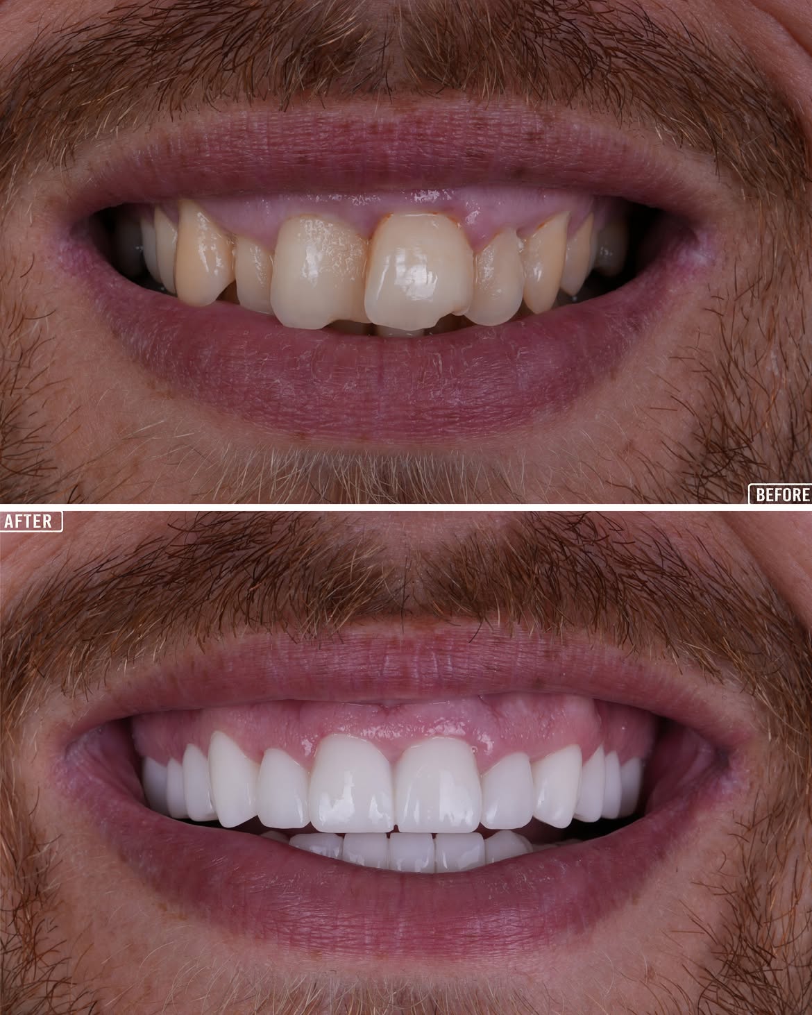 Smile Makeover Before & After in Antalya, Turkey 15