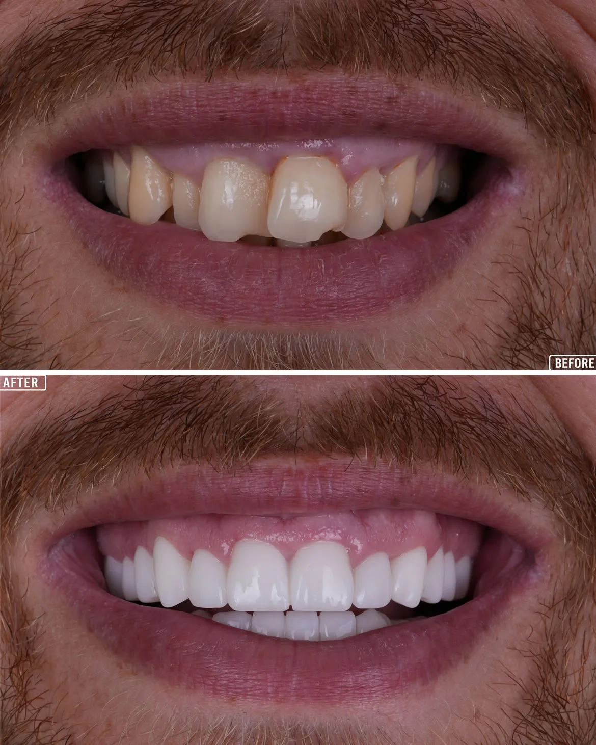 Smile Makeover Before & After in Antalya, Turkey 15