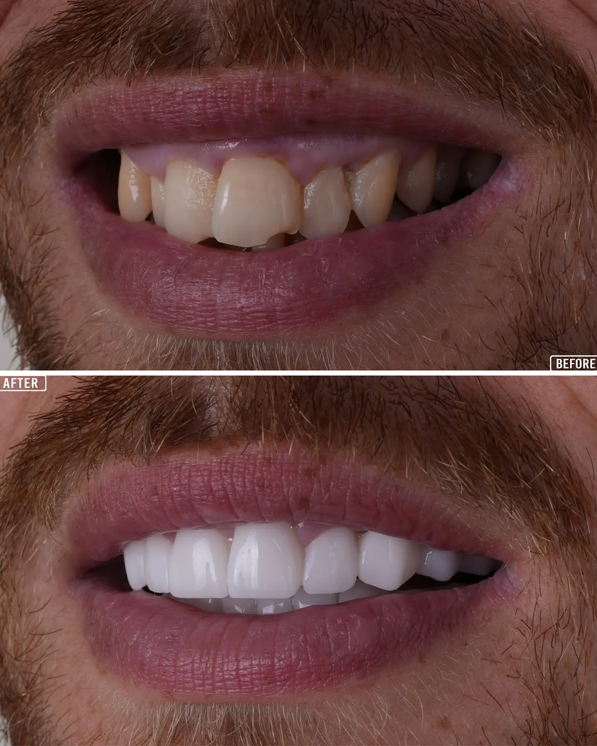 Smile Makeover Before & After in Antalya, Turkey 16