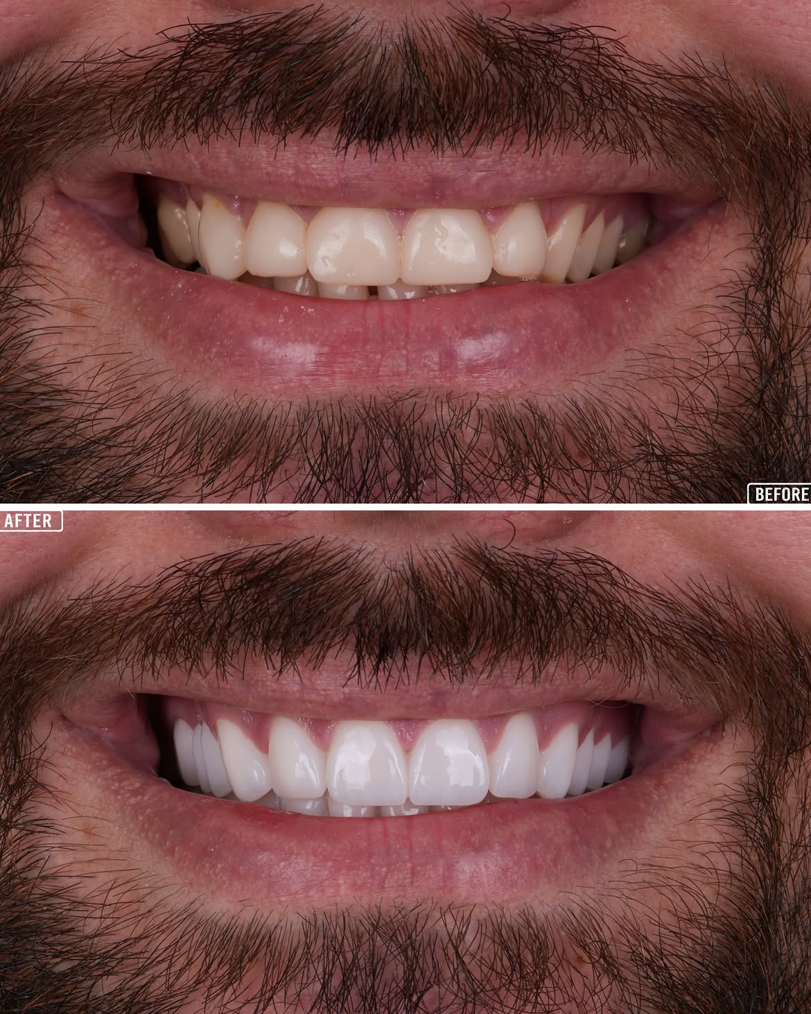 Smile Makeover Before & After in Antalya, Turkey 4