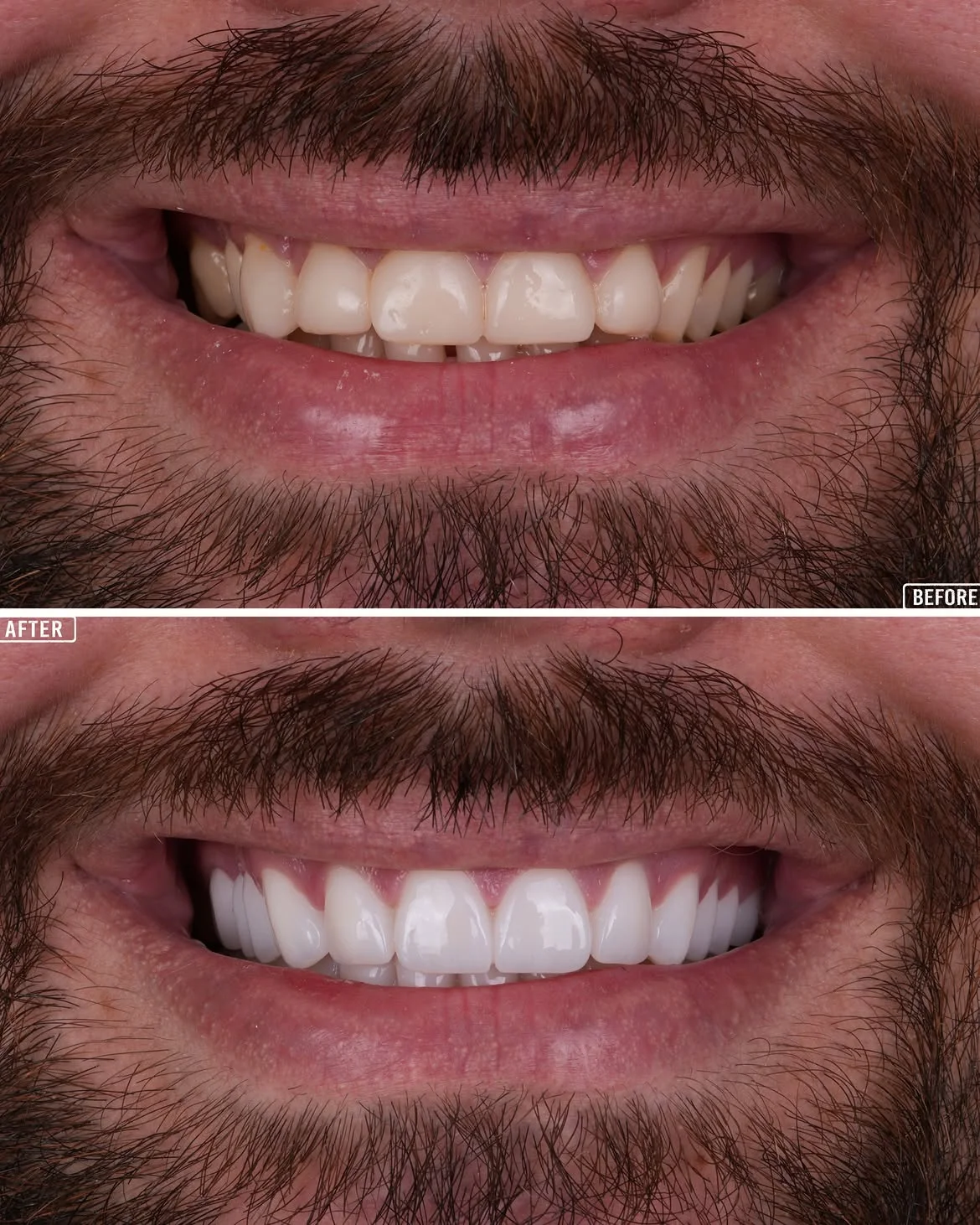 Smile Makeover Before & After in Antalya, Turkey 4