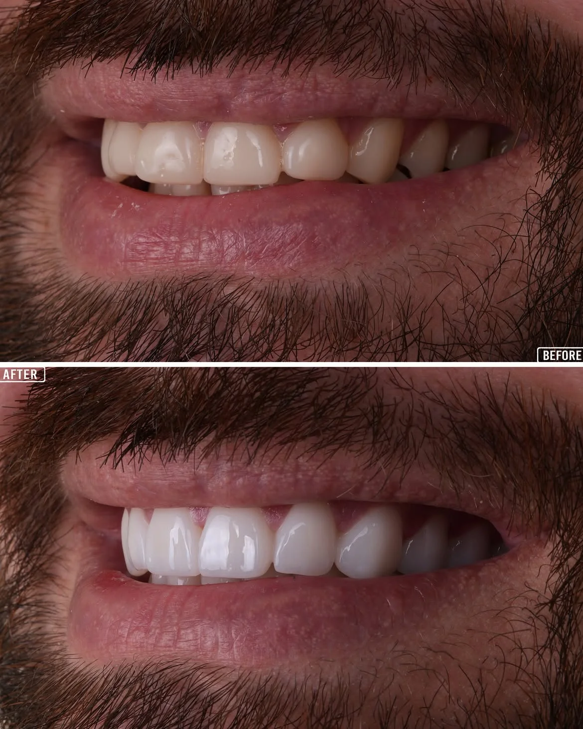 Smile Makeover Before & After in Antalya, Turkey 5
