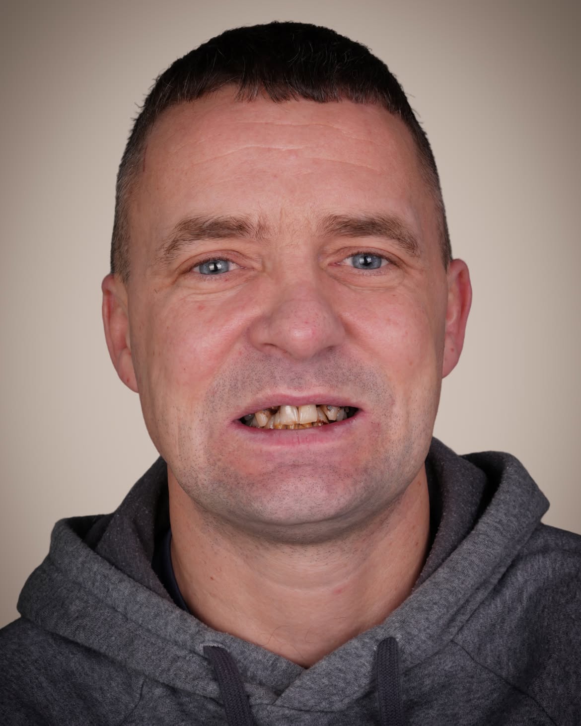 Smile Makeover Before & After in Antalya, Turkey 8