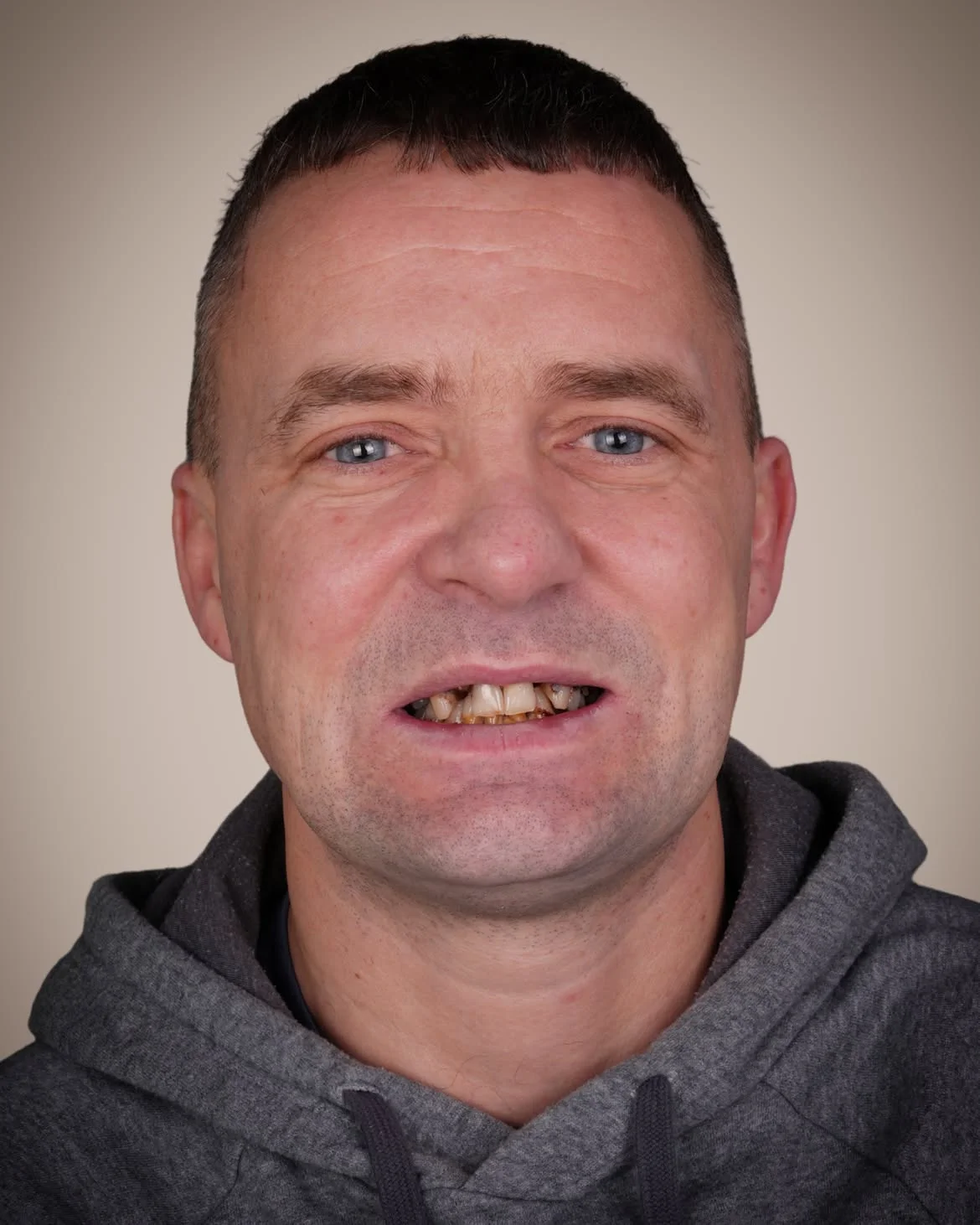 Smile Makeover Before & After in Antalya, Turkey 8
