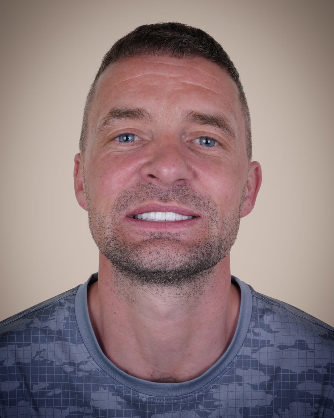 Smile Makeover Before & After in Antalya, Turkey 9
