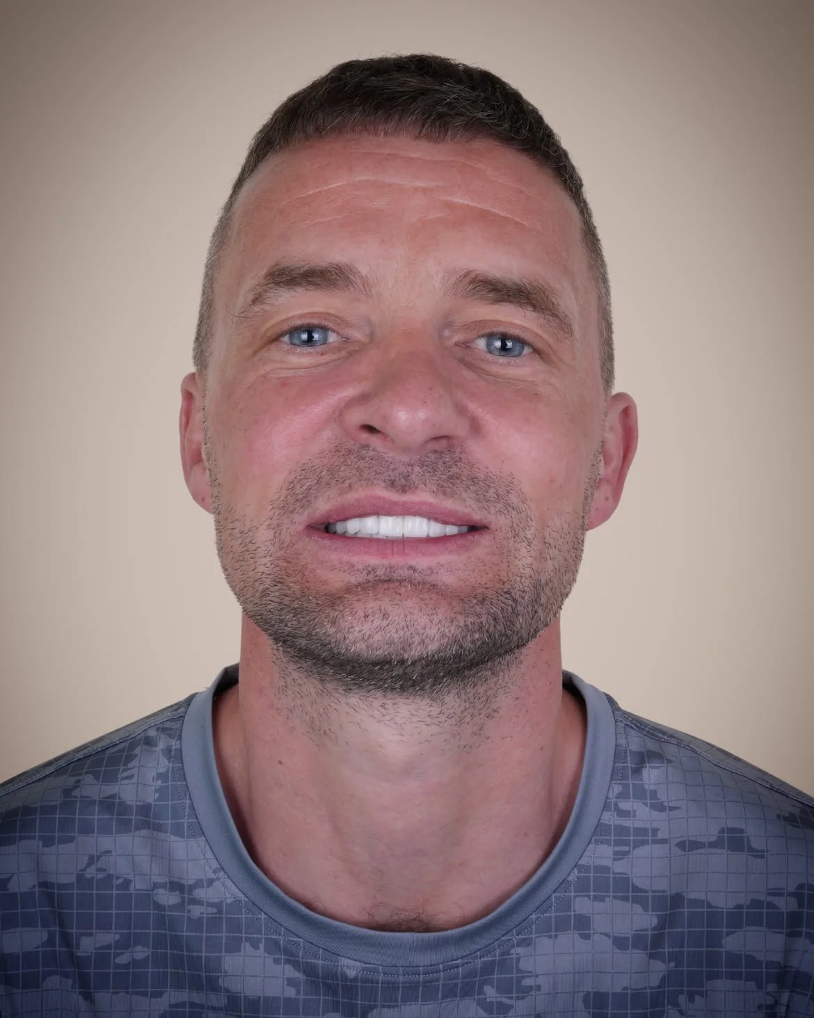 Smile Makeover Before & After in Antalya, Turkey 9