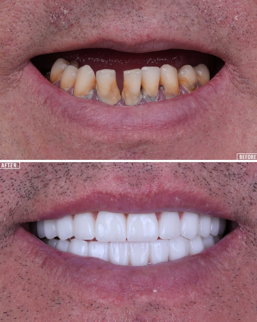 All on 4 dental implants before and after-4