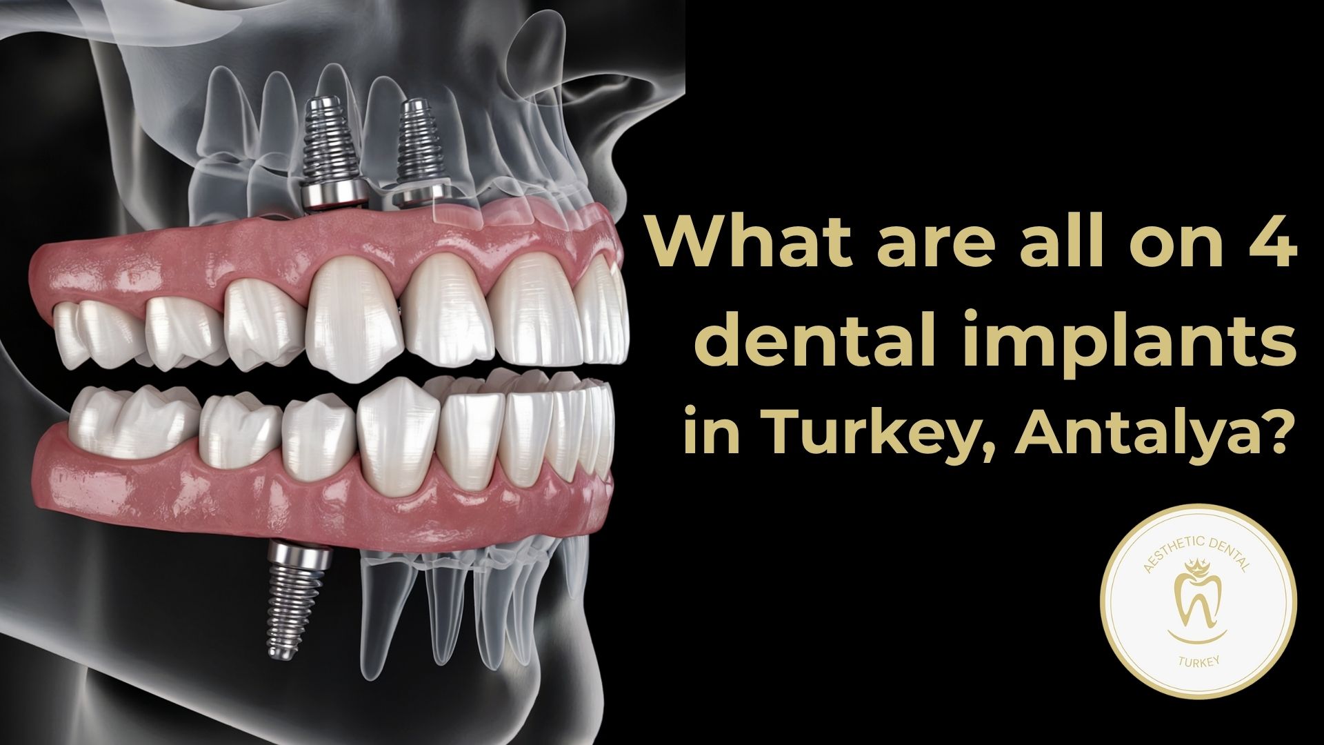 What are all on 4 dental implants in Turkey? 