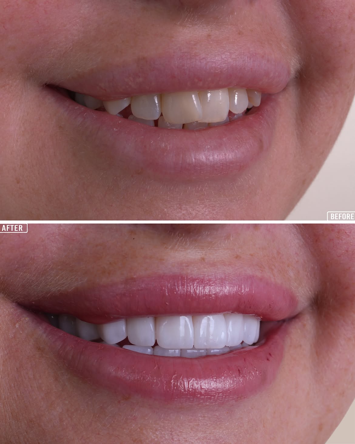Zirconium Crown Treatment Before and After